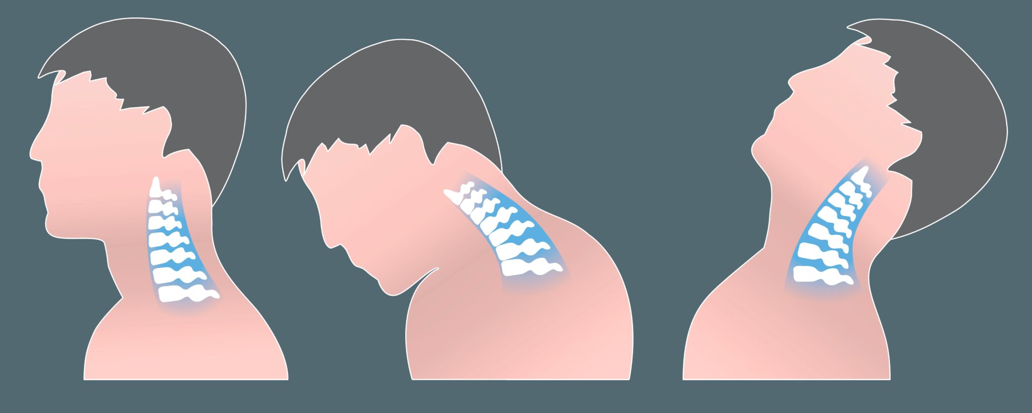 Cuál es el Tratamiento del Latigazo Cervical Consejos